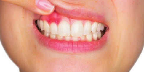 Gingivitis prije